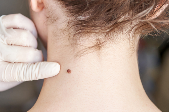 BİLGİSAYARLI DERMATOSKOP İLE BEN TAKİBİ